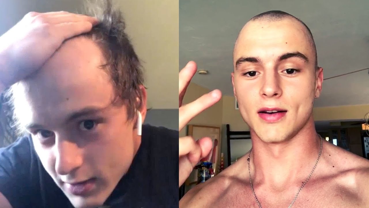 Receding hairline: Reasons, signs, Treatment and every thing